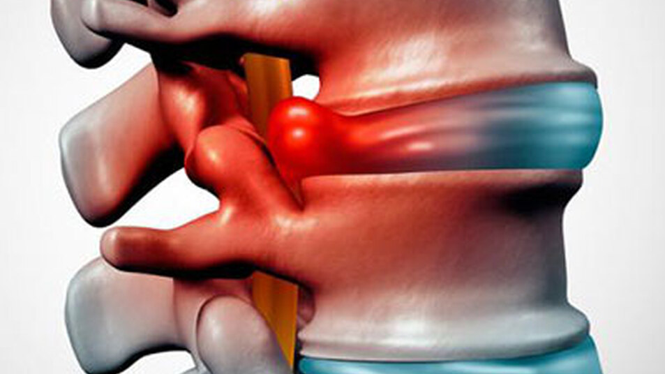 Hernia discal