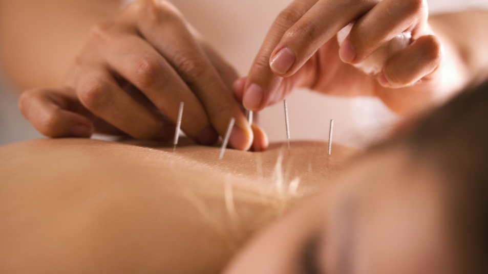 Acupuntura