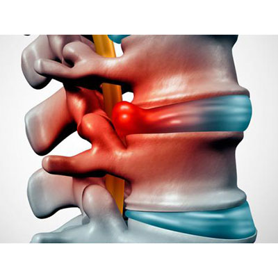 Hernia discal